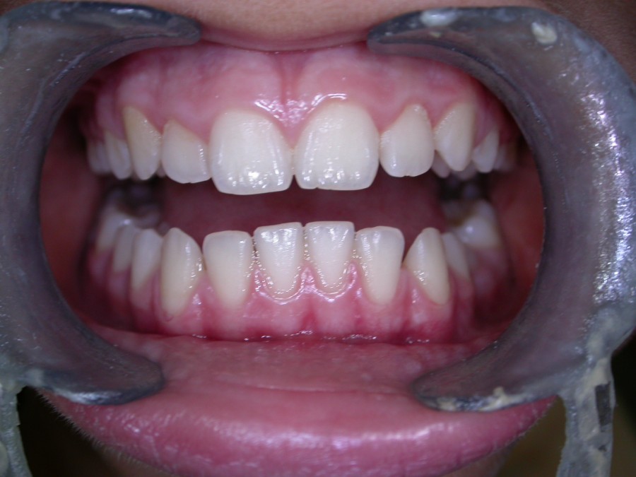 Deviazione mandibolare