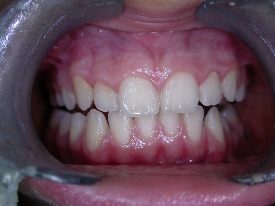 Deviazione mandibolare