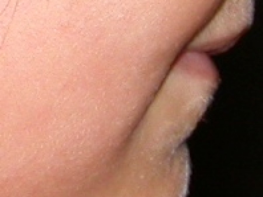 Ortodonzia Intercettiva