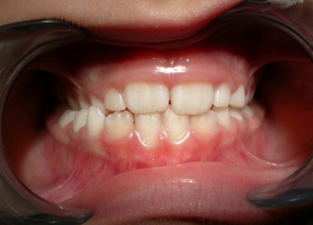 Ortodonzia in età evolutiva