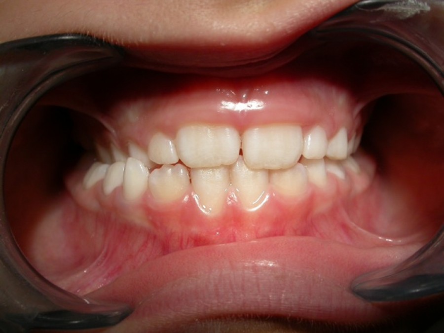 Ortodonzia in età evolutiva