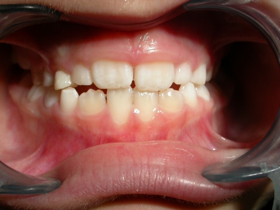 Ortodonzia in età evolutiva