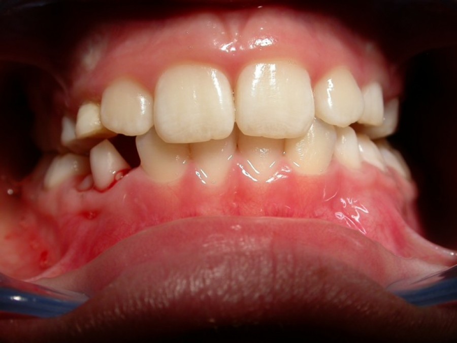 Ortodonzia in età evolutiva