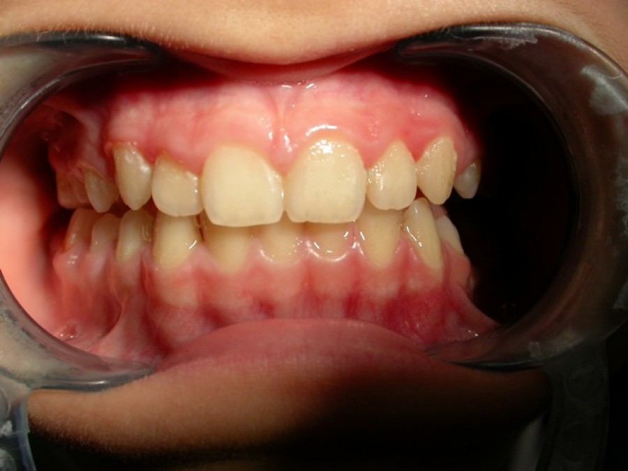 Deviazione mandibolare