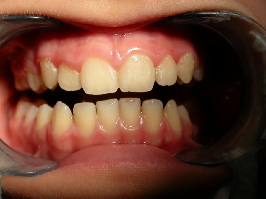 Deviazione mandibolare