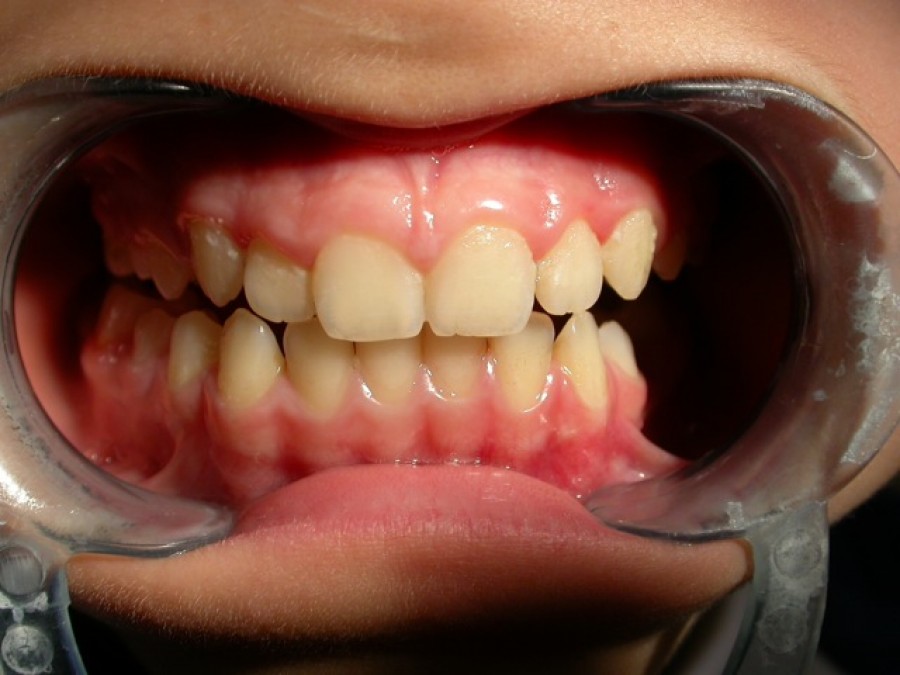 Deviazione mandibolare