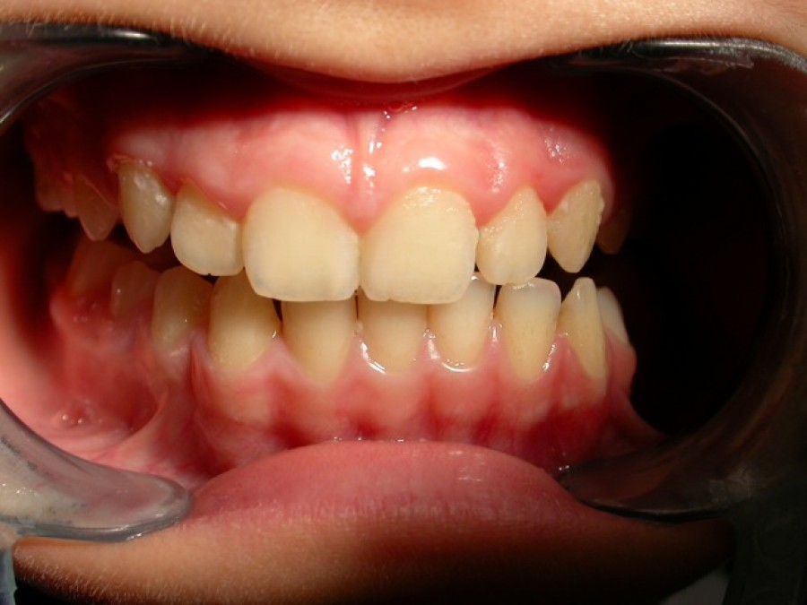 Deviazione mandibolare