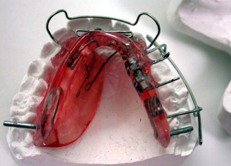 Deviazione mandibolare