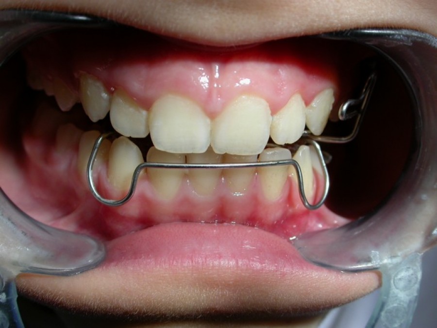 Deviazione mandibolare