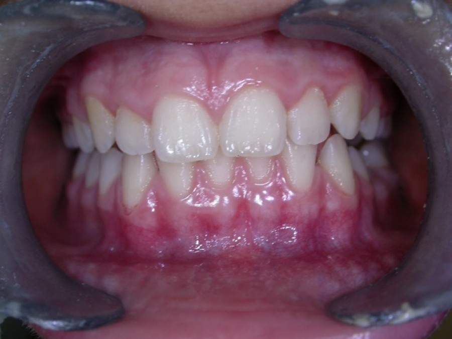 Deviazione mandibolare