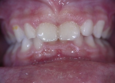 Ortodonzia Intercettiva