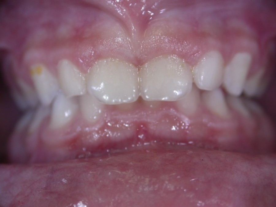 Ortodonzia Intercettiva