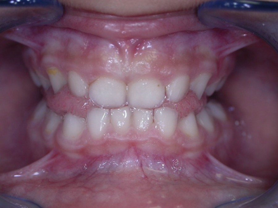 Ortodonzia Intercettiva