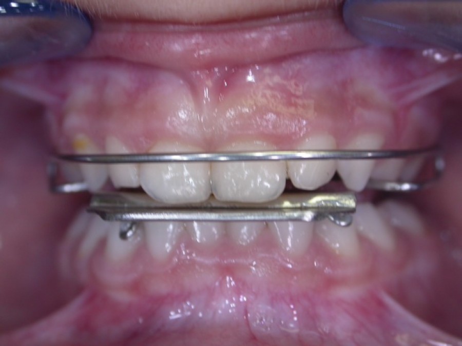 Ortodonzia Intercettiva