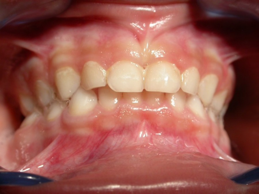 Ortodonzia Intercettiva