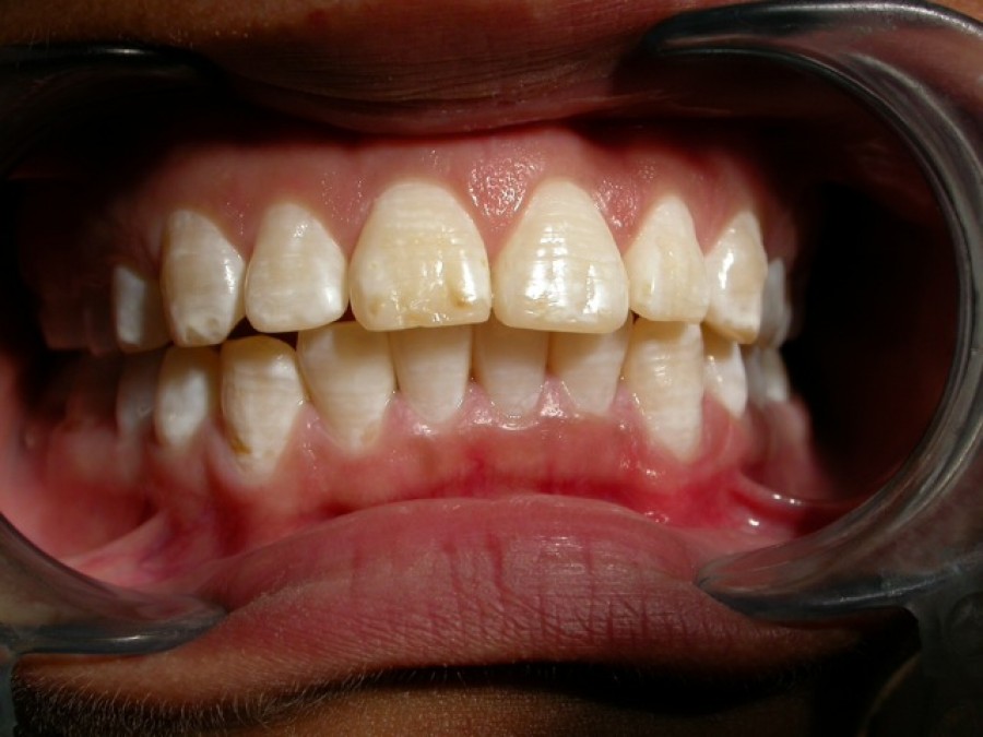 Masticatore monolaterale