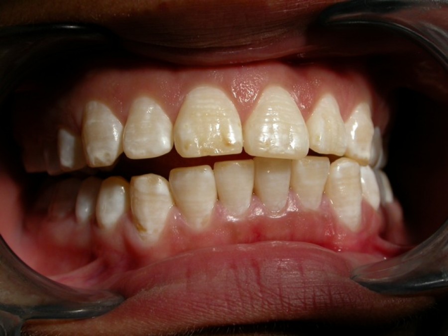 Masticatore monolaterale