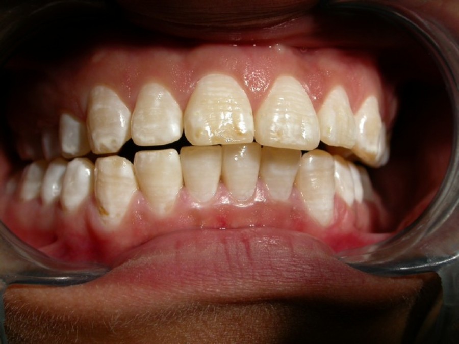 Masticatore monolaterale