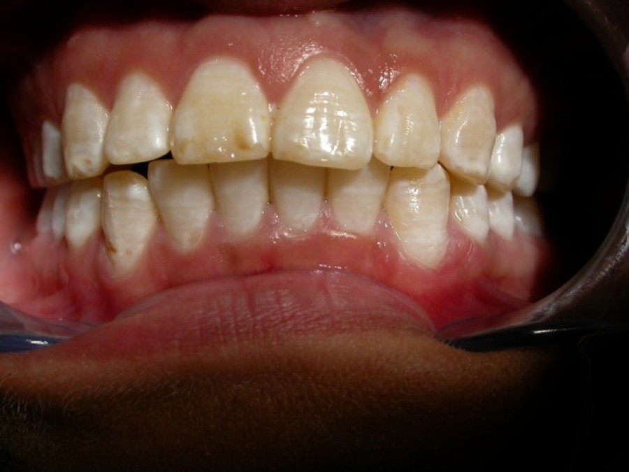 Masticatore monolaterale