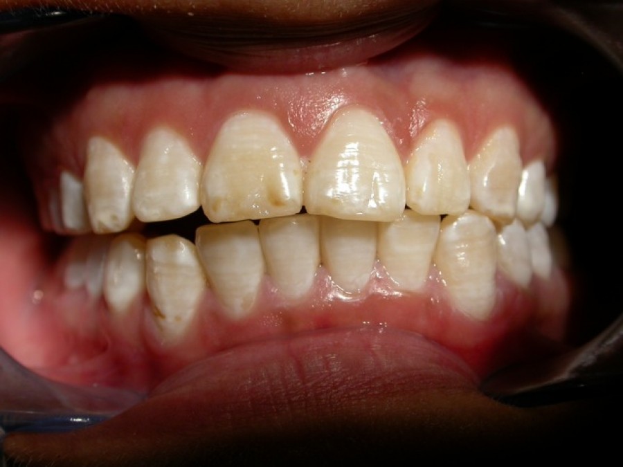 Masticatore monolaterale