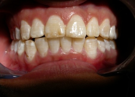 Masticatore monolaterale