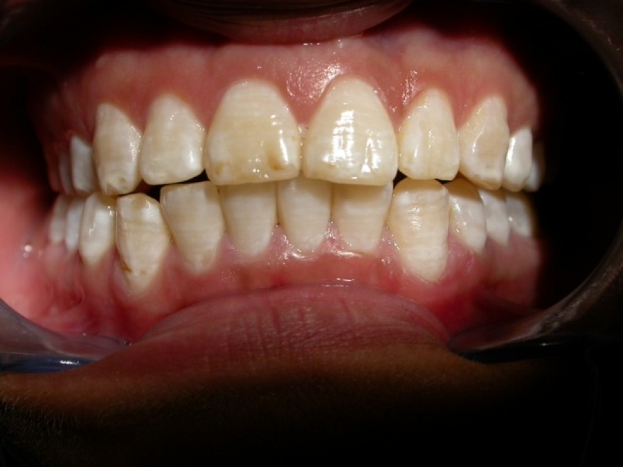 Masticatore monolaterale