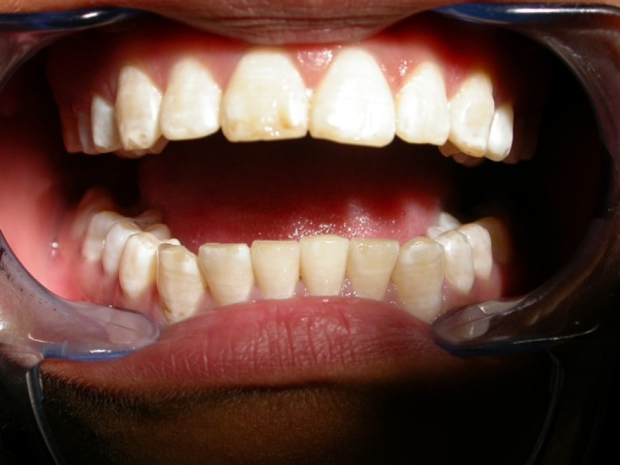 Masticatore monolaterale