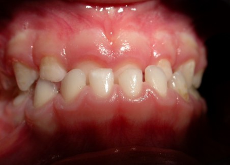 Ortodonzia Intercettiva