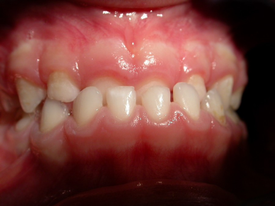 Ortodonzia Intercettiva