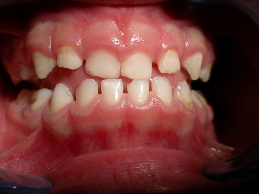 Ortodonzia Intercettiva