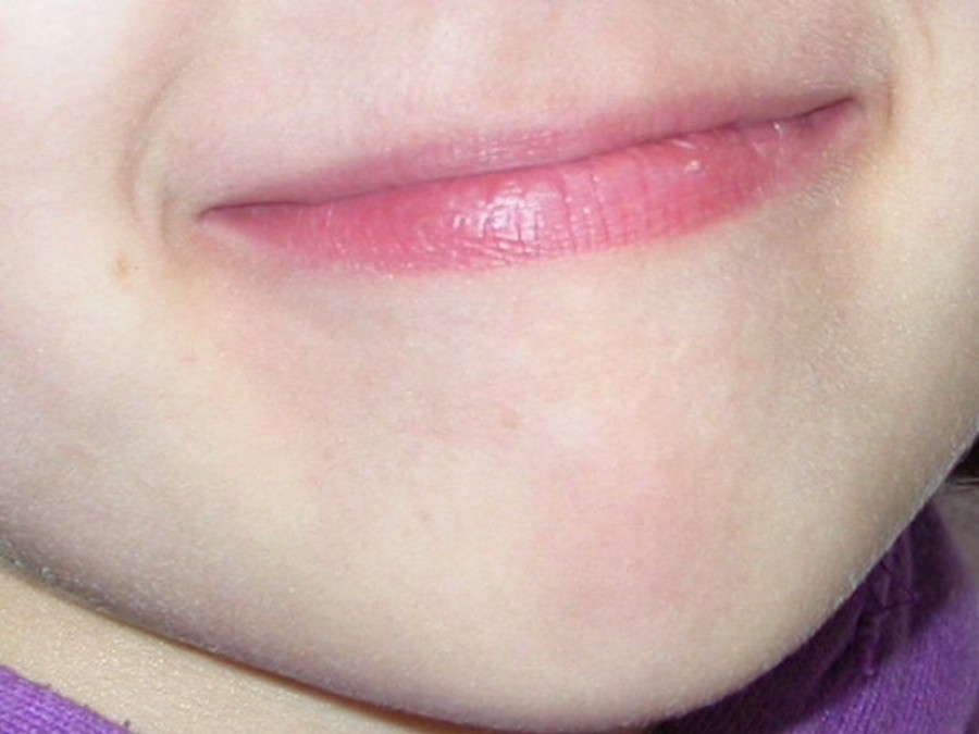 Ortodonzia Intercettiva