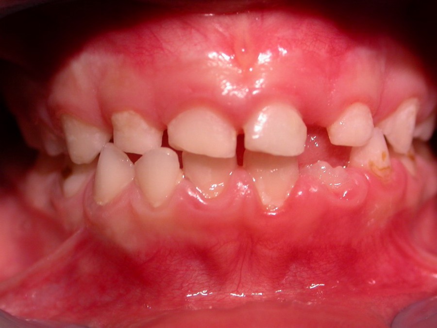 Ortodonzia Intercettiva