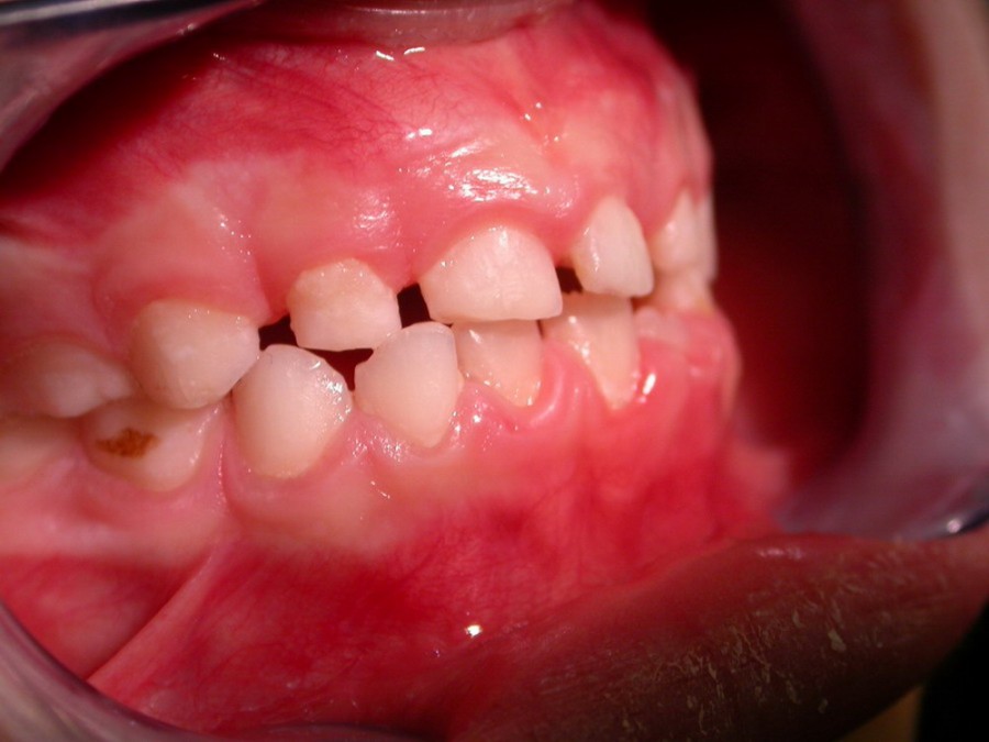 Ortodonzia Intercettiva