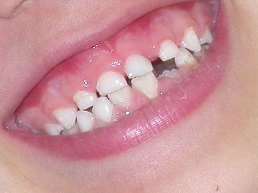 Ortodonzia Intercettiva