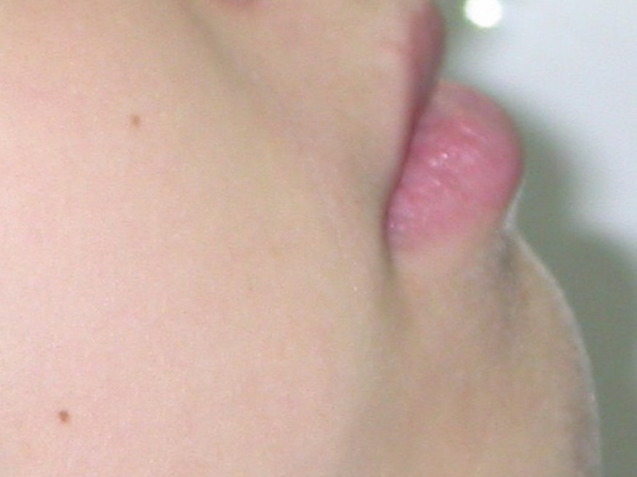 Ortodonzia Intercettiva