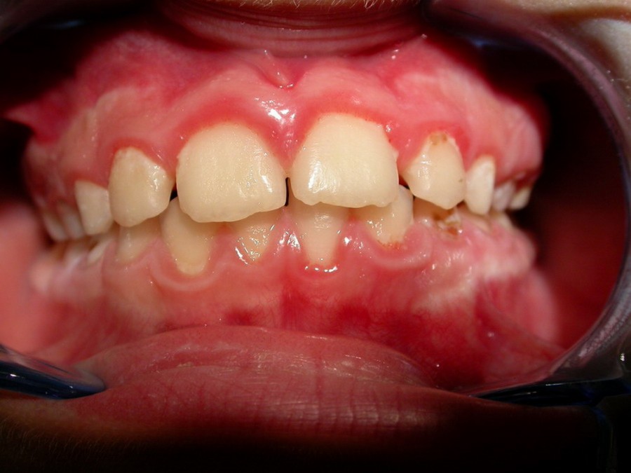 Ortodonzia Intercettiva