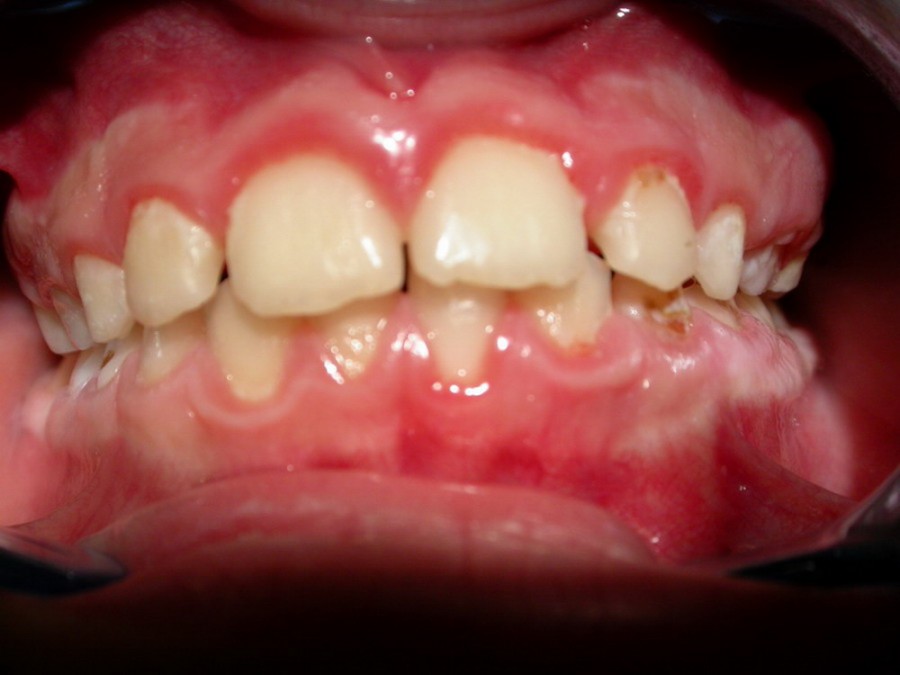 Ortodonzia Intercettiva