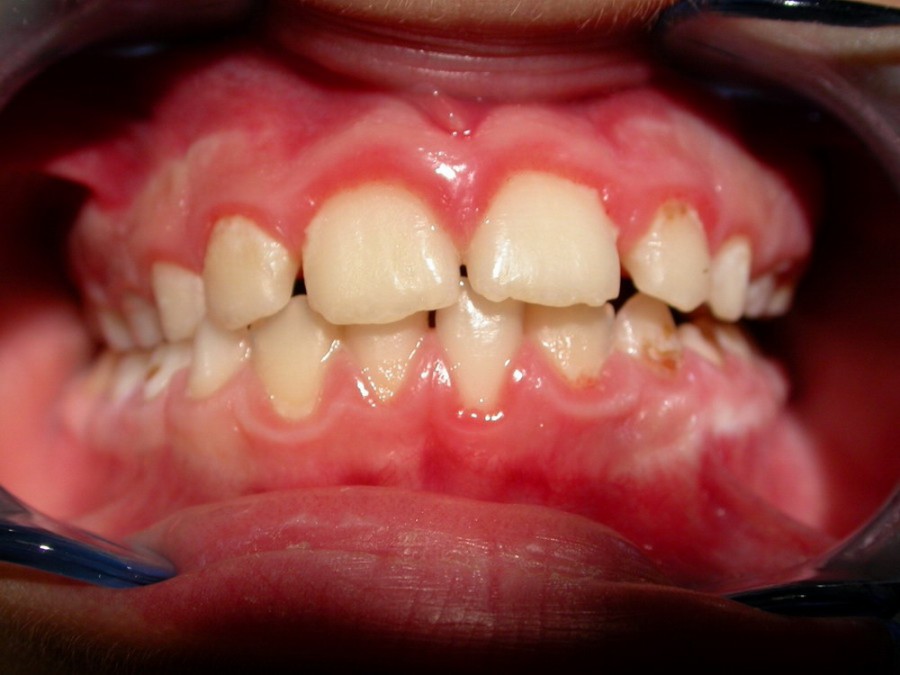 Ortodonzia Intercettiva