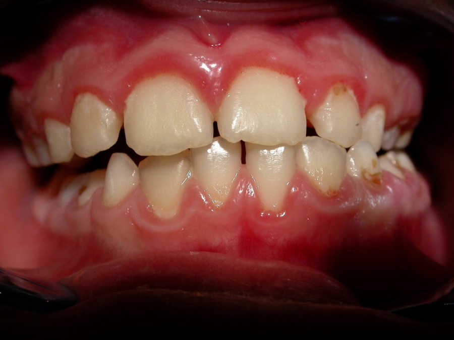 Ortodonzia Intercettiva