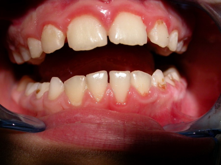 Ortodonzia Intercettiva