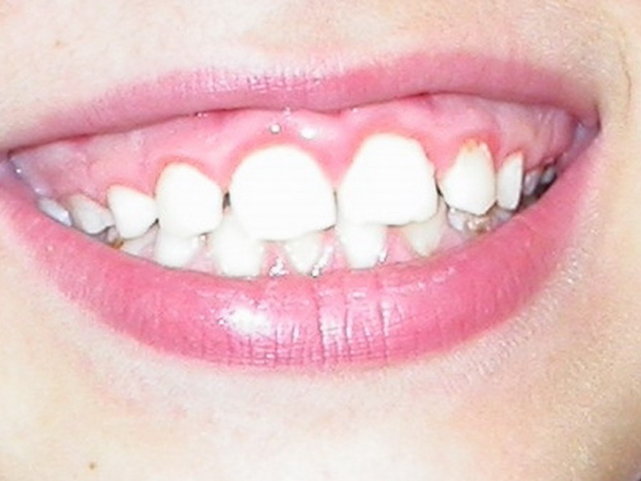 Ortodonzia Intercettiva