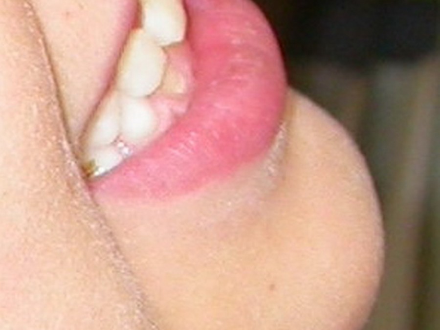 Ortodonzia Intercettiva