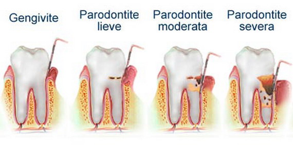 malattia-parodontale